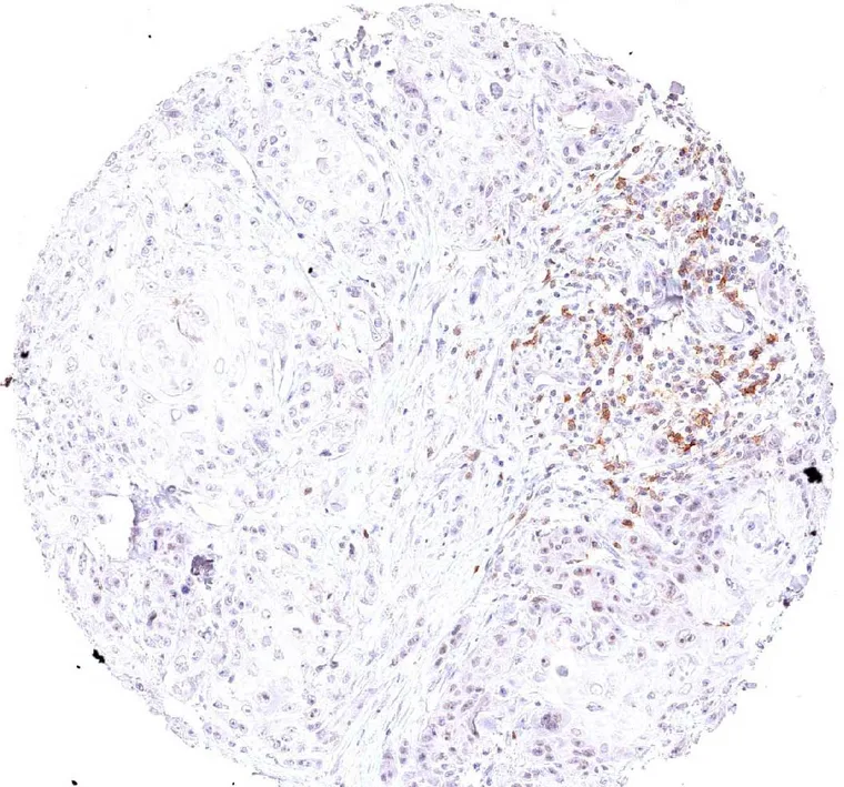 High fraction of TIGIT positive cells in peritumoral lymphocytes in a case of penis carcinoma.