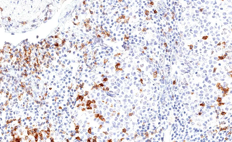 Invasive urothelial carcinoma with dense peritumoral and intratumoral infiltrate of TIGIT positive lymphocytes.