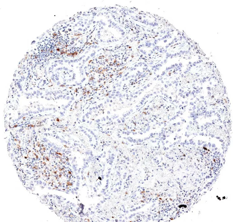 High frequency of TIGIT positive lymphocytes in an adenocarcinoma of the lung.