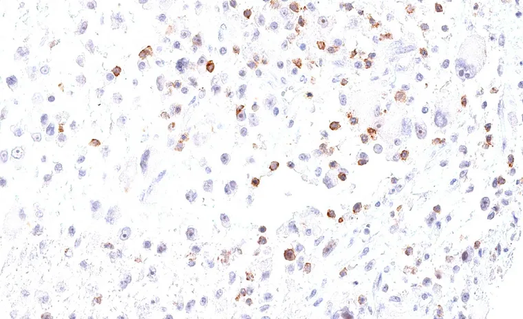 Frequent TIGIT positive lymphocytes in a liposarcoma.