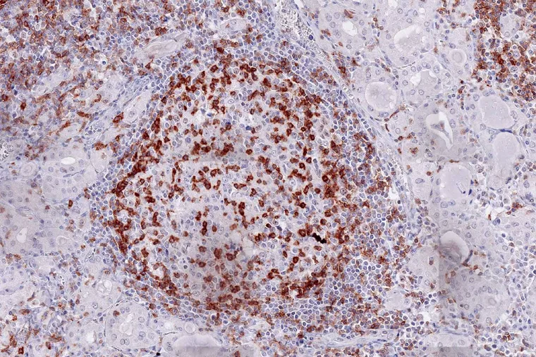 Inflammatory lymphoid infiltrate in Hashimoto thyroiditis (ONCOdianova reference image, datasheet V17, Fig. C).
