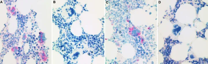 CAL2-IHC an vier MPN-Fällen, zwei positiv und zwei negativ.