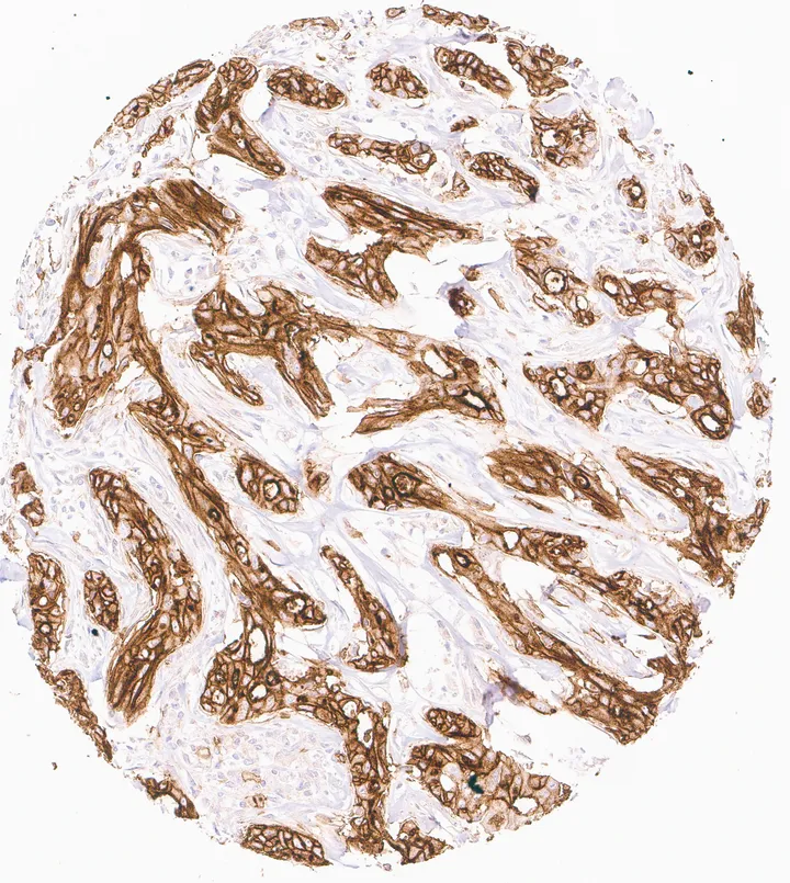 Immunhistochemischer Nachweis von humanem CD73 (NT5E) mit Anti-CD73-Klon KK3 (DIA-KK3) in FFPE-Gewebe – starke homogene CD73-Immunfärbung in einem cholangiozellulären Karzinom der Leber; Abbildung 01 der bisherigen ONCOdianova-CD73-Galerie.
