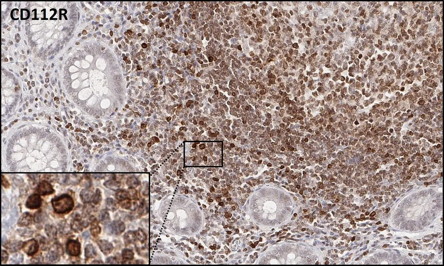 Immunhistochemischer Nachweis von humanem CD112R/PVRIG mit Anti-CD112R/PVRIG-Klon R12 (DIA-R12) – Hellfeld-IHC einer normalen humanen Tonsille mit zahlreichen CD112R/PVRIG-positiven Lymphozyten (Datenblatt DIA-R12, Abbildung A, dasselbe Gesichtsfeld); Abbildung 03 der ONCOdianova-CD112R-Galerie.