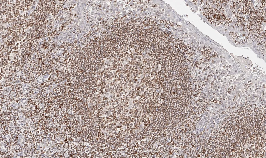 Immunhistochemischer Nachweis von humanem CD112R/PVRIG mit Anti-CD112R/PVRIG-Klon R12 (DIA-R12) in FFPE-Gewebe – Hellfeld-IHC, Abbildung 04 der ONCOdianova-CD112R-Galerie.