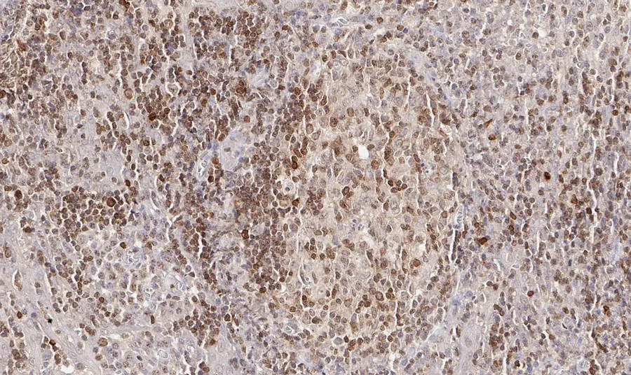 Immunhistochemischer Nachweis von humanem CD112R/PVRIG mit Anti-CD112R/PVRIG-Klon R12 (DIA-R12) in FFPE-Gewebe – Hellfeld-IHC, Abbildung 07 der ONCOdianova-CD112R-Galerie.