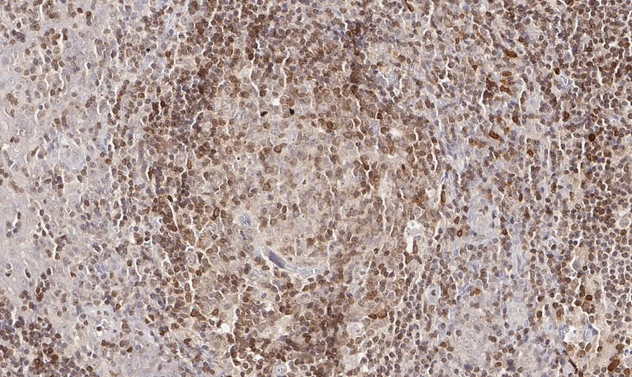 Immunhistochemischer Nachweis von humanem CD112R/PVRIG mit Anti-CD112R/PVRIG-Klon R12 (DIA-R12) in FFPE-Gewebe – Hellfeld-IHC, Abbildung 08 der ONCOdianova-CD112R-Galerie.