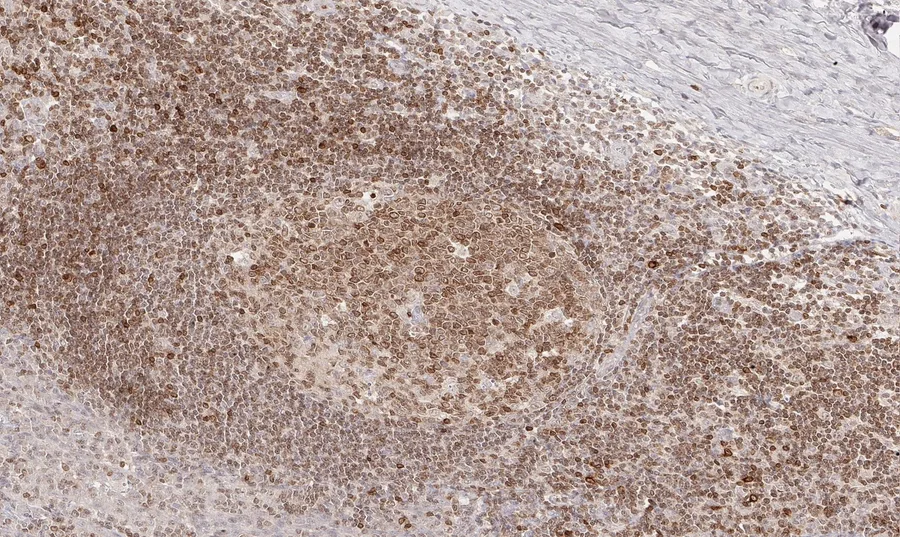 Immunhistochemischer Nachweis von humanem CD112R/PVRIG mit Anti-CD112R/PVRIG-Klon R12 (DIA-R12) in FFPE-Gewebe – Hellfeld-IHC, Abbildung 09 der ONCOdianova-CD112R-Galerie.