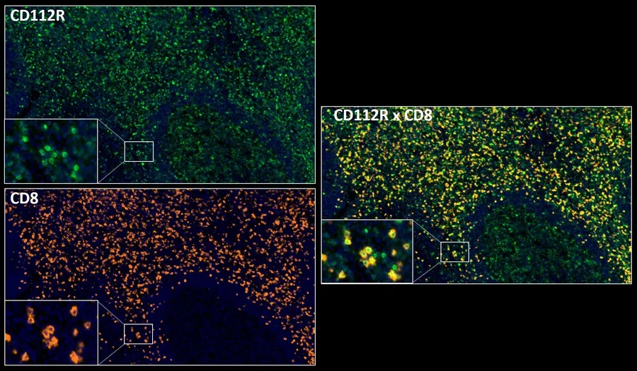 Fluoreszenz-Multiplex-Immunhistochemie von CD112R/PVRIG (Klon R12, DIA-R12; grün) und CD8 (orange) in humanem FFPE-Gewebe – Einzelkanäle CD112R (grün) und CD8 (orange) mit Detaileinschüben sowie Überlagerung CD112R × CD8; Abbildung 02 der ONCOdianova-CD112R-Galerie.