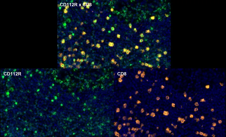 Fluoreszenz-Multiplex-Immunhistochemie von CD112R/PVRIG (Klon R12, DIA-R12; grün) und CD8 (orange) in humanem FFPE-Gewebe – Überlagerung CD112R × CD8 (oben) und Einzelkanäle CD112R und CD8 (unten), höhere Vergrößerung; Abbildung 10 der ONCOdianova-CD112R-Galerie.