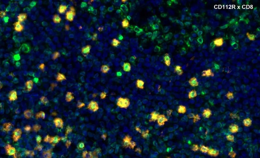 Fluoreszenz-Multiplex-Immunhistochemie von CD112R/PVRIG (Klon R12, DIA-R12; grün) und CD8 (orange) in humanem FFPE-Gewebe – Überlagerung CD112R × CD8, höhere Vergrößerung; doppelt positive Zellen erscheinen gelb; Abbildung 11 der ONCOdianova-CD112R-Galerie.