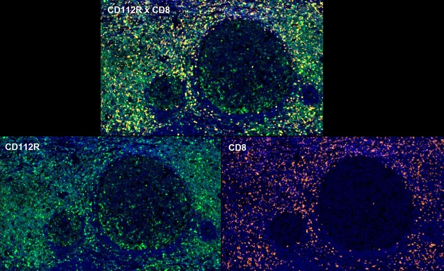 Fluoreszenz-Multiplex-Immunhistochemie von CD112R/PVRIG (Klon R12, DIA-R12; grün) und CD8 (orange) in humanem FFPE-Gewebe – Überlagerung CD112R × CD8 (oben) und Einzelkanäle CD112R und CD8 (unten) um Lymphfollikel; Abbildung 12 der ONCOdianova-CD112R-Galerie.