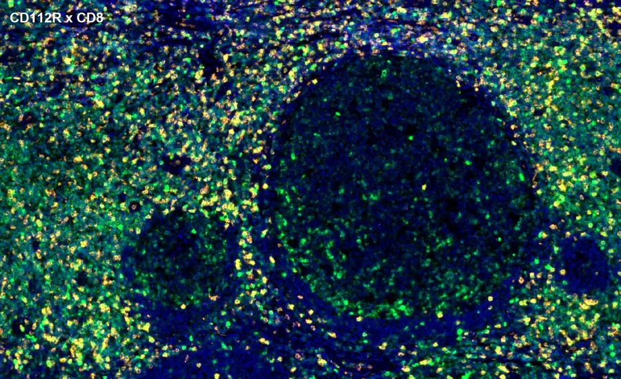 Fluoreszenz-Multiplex-Immunhistochemie von CD112R/PVRIG (Klon R12, DIA-R12; grün) und CD8 (orange) in humanem FFPE-Gewebe – Überlagerung CD112R × CD8 um Lymphfollikel, Übersicht; Abbildung 13 der ONCOdianova-CD112R-Galerie.
