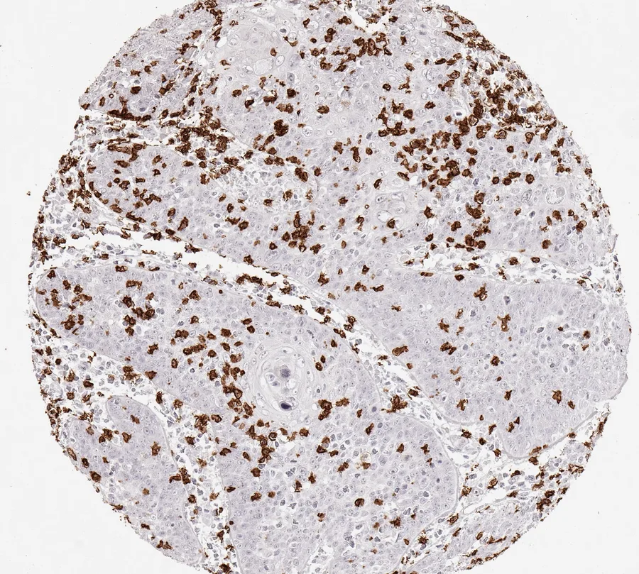Immunohistochemistry of human CD8 with anti-CD8 clone TC8 (DIA-TC8) in FFPE tissue – scattered CD8-positive lymphocytes in anal squamous cell carcinoma; figure 30 of the ONCOdianova CD8 gallery.