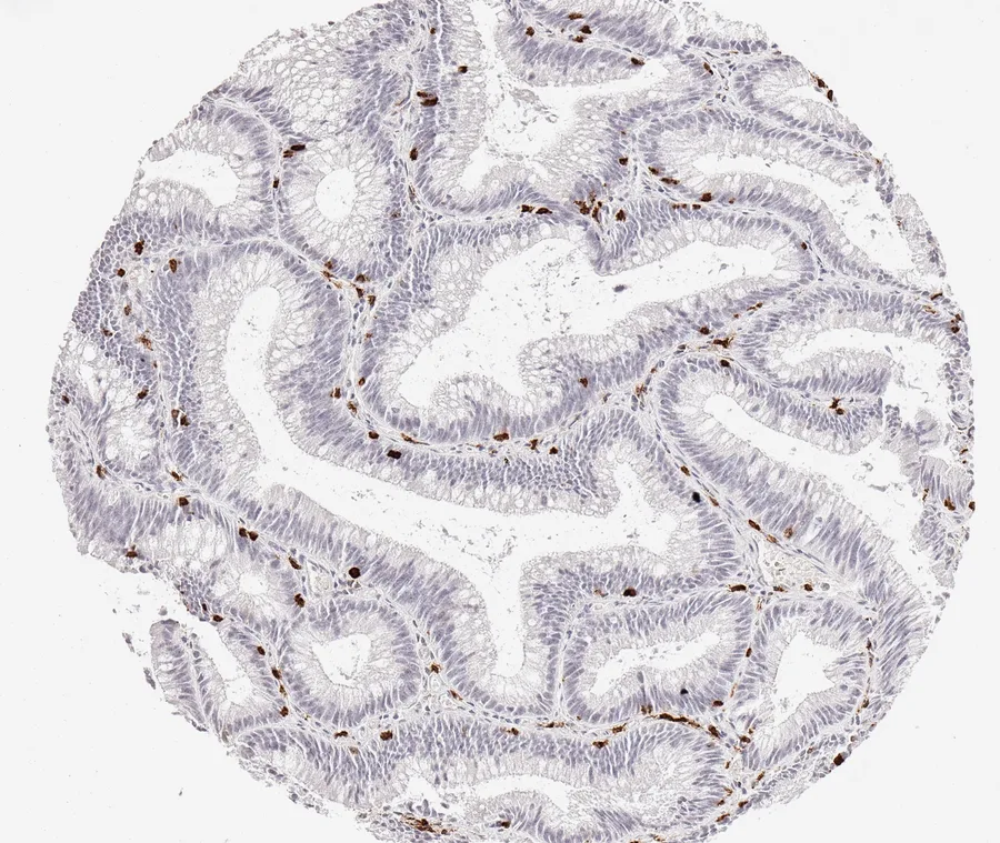 Immunohistochemistry of human CD8 with anti-CD8 clone TC8 (DIA-TC8) in FFPE tissue – CD8-positive lymphocytes in a low-grade tubular adenoma of the colon; figure 27 of the ONCOdianova CD8 gallery (legend of the ONCOdianova product documentation).