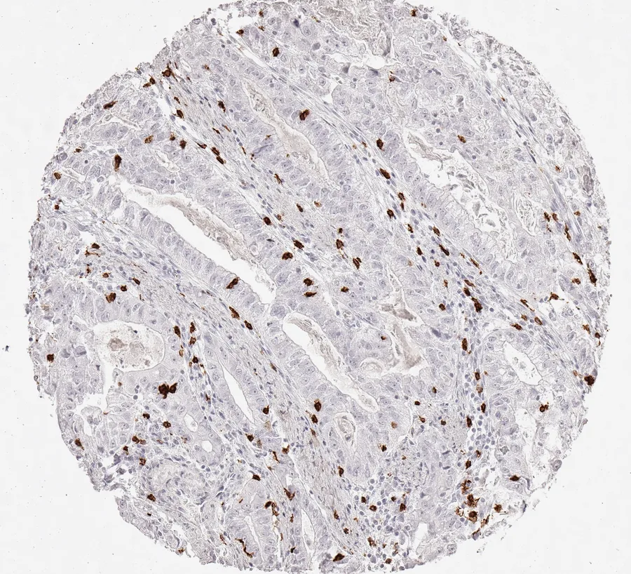 Immunohistochemistry of human CD8 with anti-CD8 clone TC8 (DIA-TC8) in FFPE tissue – relatively few CD8-positive cells in intestinal-type gastric cancer; figure 09 of the ONCOdianova CD8 gallery.