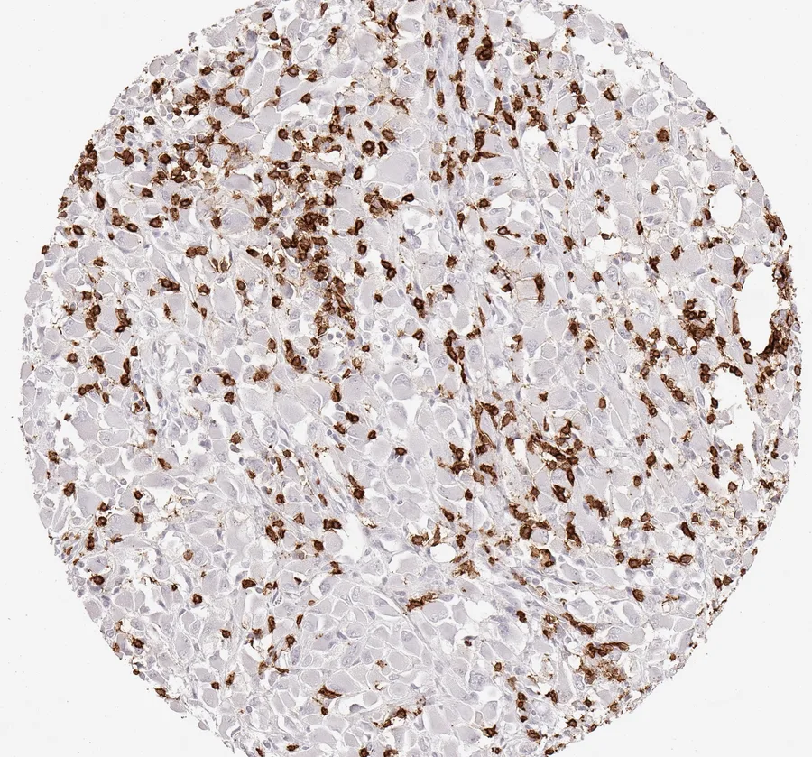 Immunohistochemistry of human CD8 with anti-CD8 clone TC8 (DIA-TC8) in FFPE tissue – CD8-positive lymphocytes in kidney cancer; figure 21 of the ONCOdianova CD8 gallery.