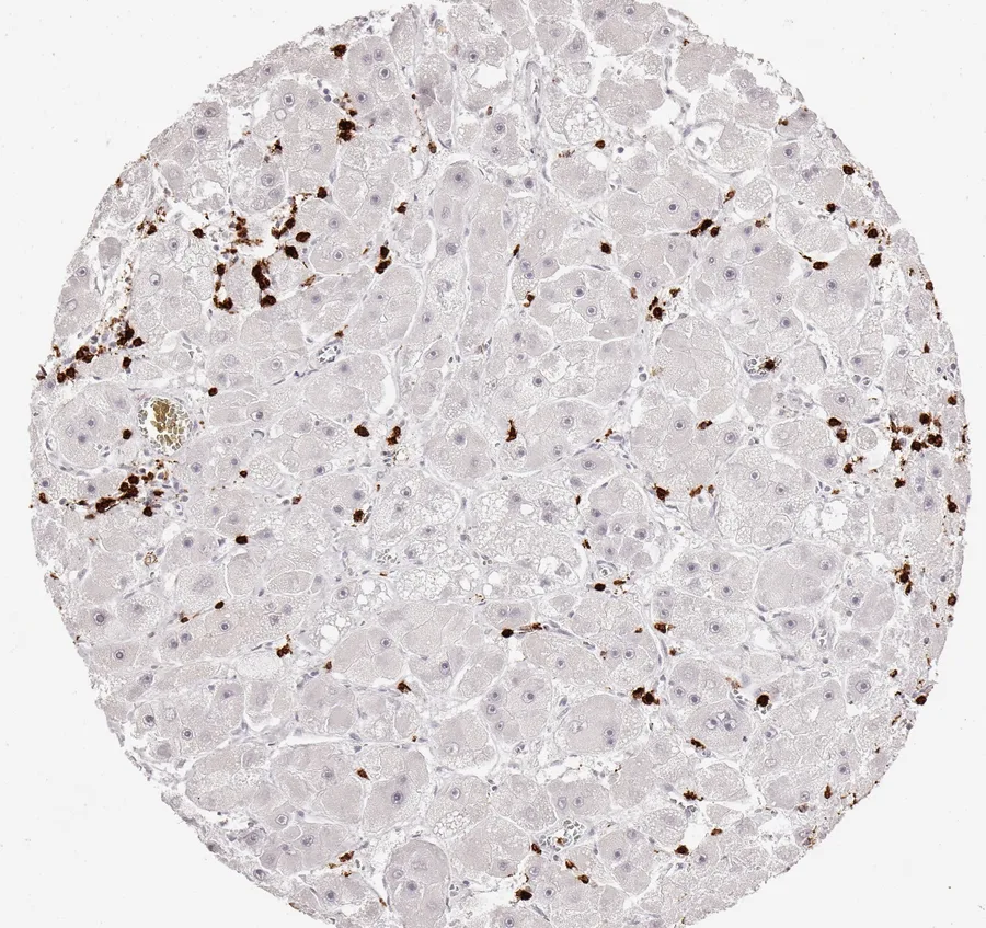Immunohistochemistry of human CD8 with anti-CD8 clone TC8 (DIA-TC8) in FFPE tissue – CD8-positive lymphocytes, moderate density in liver cell cancer; figure 26 of the ONCOdianova CD8 gallery.