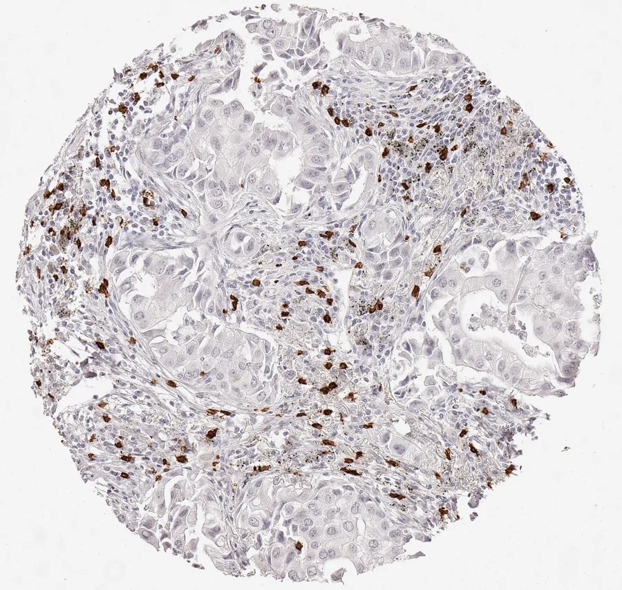 Immunohistochemistry of human CD8 with anti-CD8 clone TC8 (DIA-TC8) in FFPE tissue – marked infiltration by CD8-positive lymphocytes, almost exclusively located in the tumour stroma without immediate contact to neoplastic cells in adenocarcinoma of the lung; figure 04 of the ONCOdianova CD8 gallery.