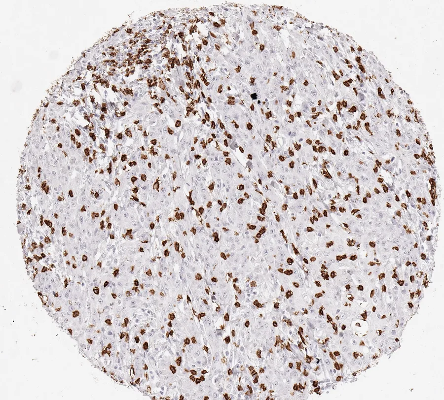 Immunohistochemistry of human CD8 with anti-CD8 clone TC8 (DIA-TC8) in FFPE tissue – CD8-positive lymphocytes in squamous cell carcinoma of the oral cavity; figure 36 of the ONCOdianova CD8 gallery.