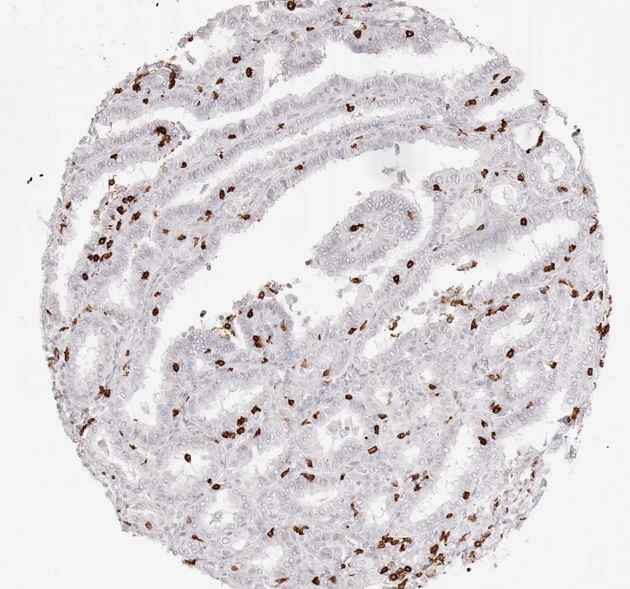 Immunohistochemistry of human CD8 with anti-CD8 clone TC8 (DIA-TC8) in FFPE tissue – CD8-positive lymphocytes in papillary carcinoma of the thyroid; figure 33 of the ONCOdianova CD8 gallery.