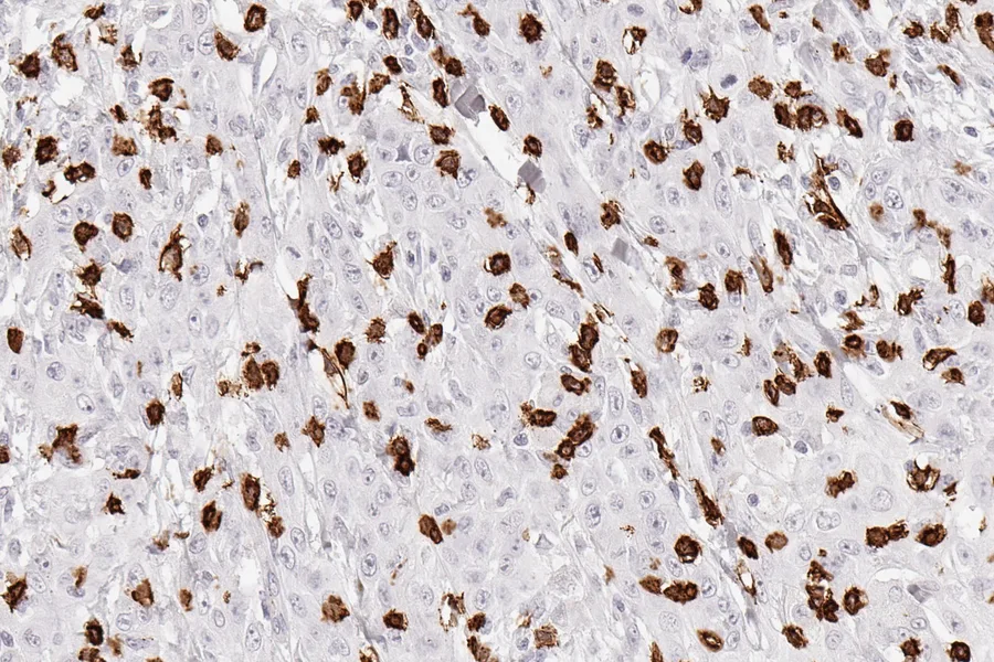 Immunohistochemistry of human CD8 with anti-CD8 clone TC8 (DIA-TC8) in FFPE tissue – CD8-positive lymphocytes; product image of the ONCOdianova product documentation DIA-TC8 and preview image of the ONCOdianova CD8 pages.