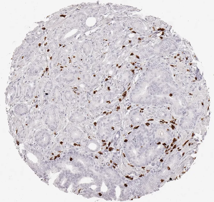 Immunhistochemischer Nachweis von humanem CD8 mit Anti-CD8-Klon TC8 (DIA-TC8) in FFPE-Gewebe – dichtes Infiltrat CD8-positiver Lymphozyten in einem Adenokarzinom der Prostata; Abbildung 01 der bisherigen ONCOdianova-CD8-Galerie.
