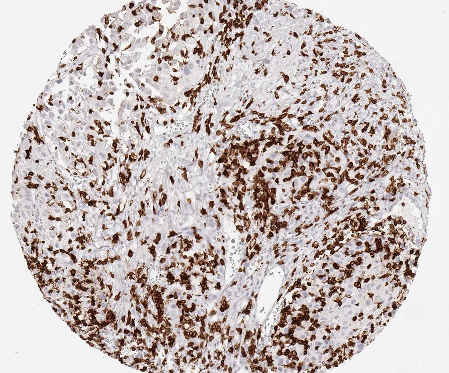 Immunohistochemistry of human CD8 with anti-CD8 clone TC8 (DIA-TC8) in FFPE tissue – dense infiltrate of CD8-positive lymphocytes in muscle-invasive urothelial carcinoma of the urinary bladder; figure 25 of the ONCOdianova CD8 gallery.