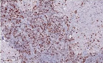 Sarcoid granuloma interspersed with TIGIT-positive lymphocytes (ONCOdianova reference image, datasheet V17, Fig. D).