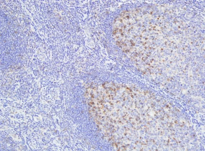 TIGIT IHC on tonsil after heat-induced epitope retrieval at pH 9.0 (left) versus pH 6.0 (right), Leica Bond RX (ONCOdianova reference images, Tech Note V1, p. 5). – HIER pH 6.0