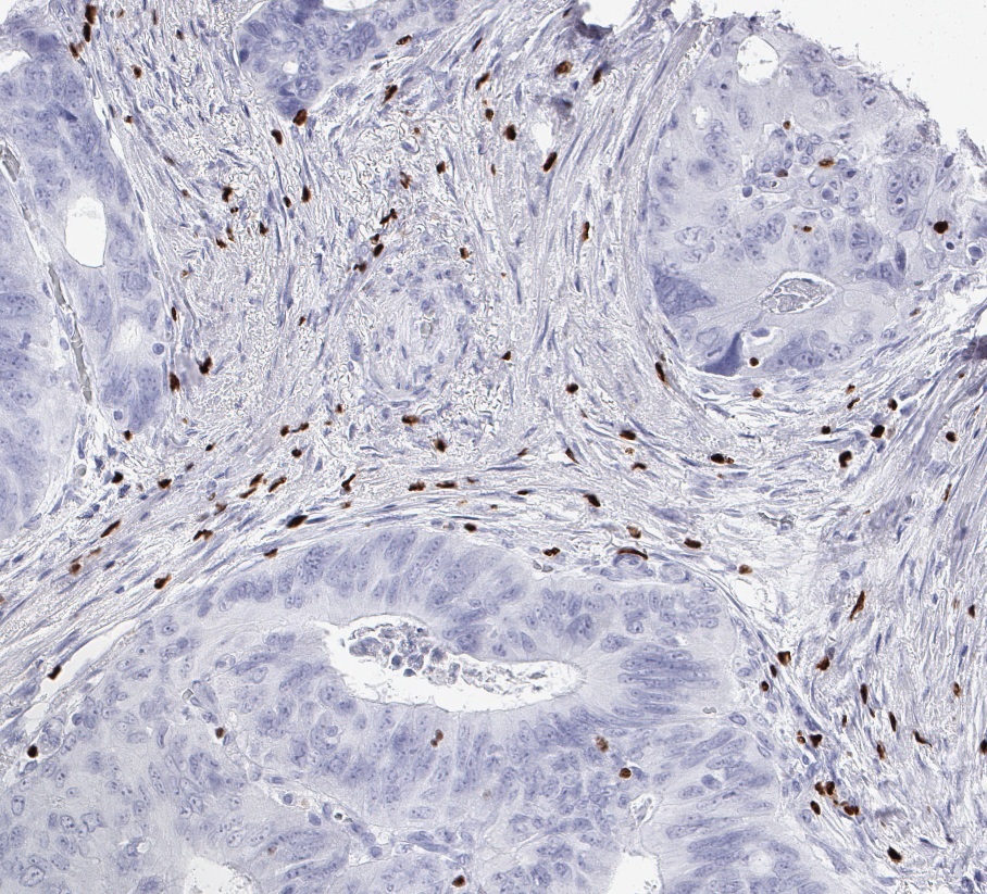 Product image of the ONCOdianova anti-FOXP3 antibody clone FX3: FOXP3 immunohistochemistry of FOXP3-positive regulatory T cells in the stroma of a colorectal adenocarcinoma