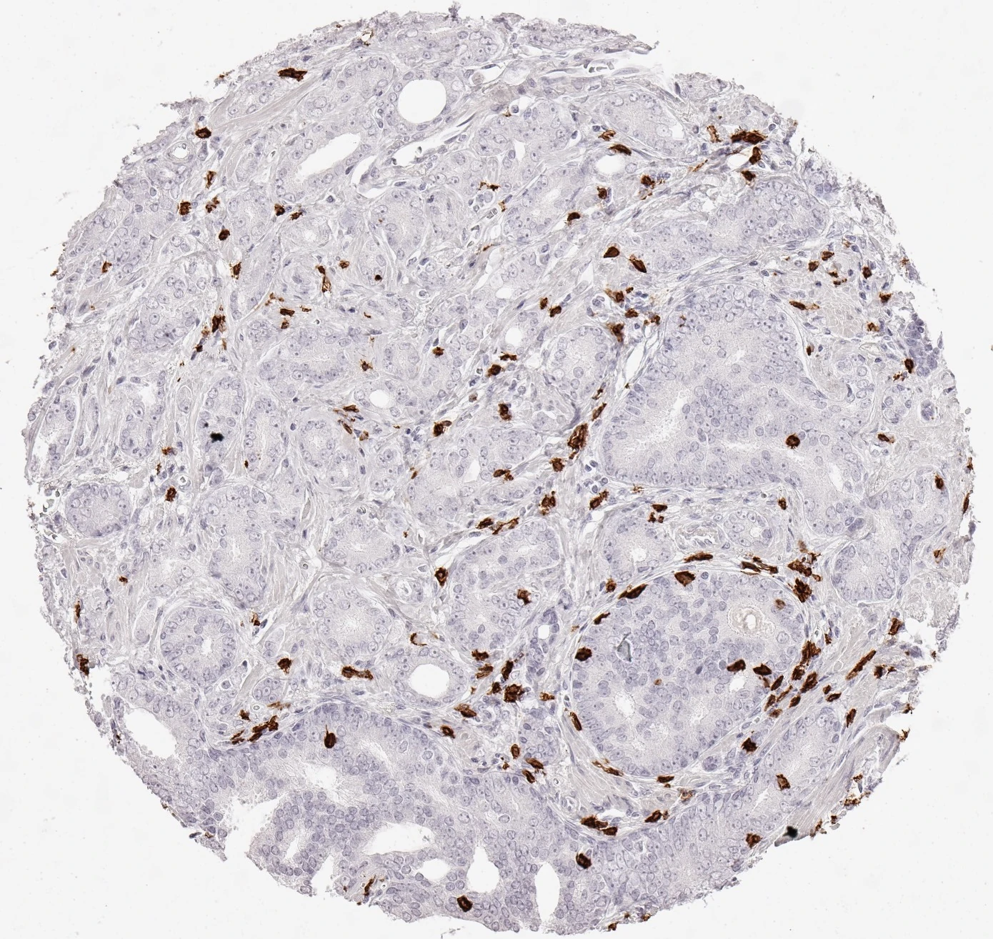 Product image of the ONCOdianova anti-CD8 antibody clone TC8: CD8 immunohistochemistry showing a dense infiltrate of CD8-positive lymphocytes in adenocarcinoma of the prostate