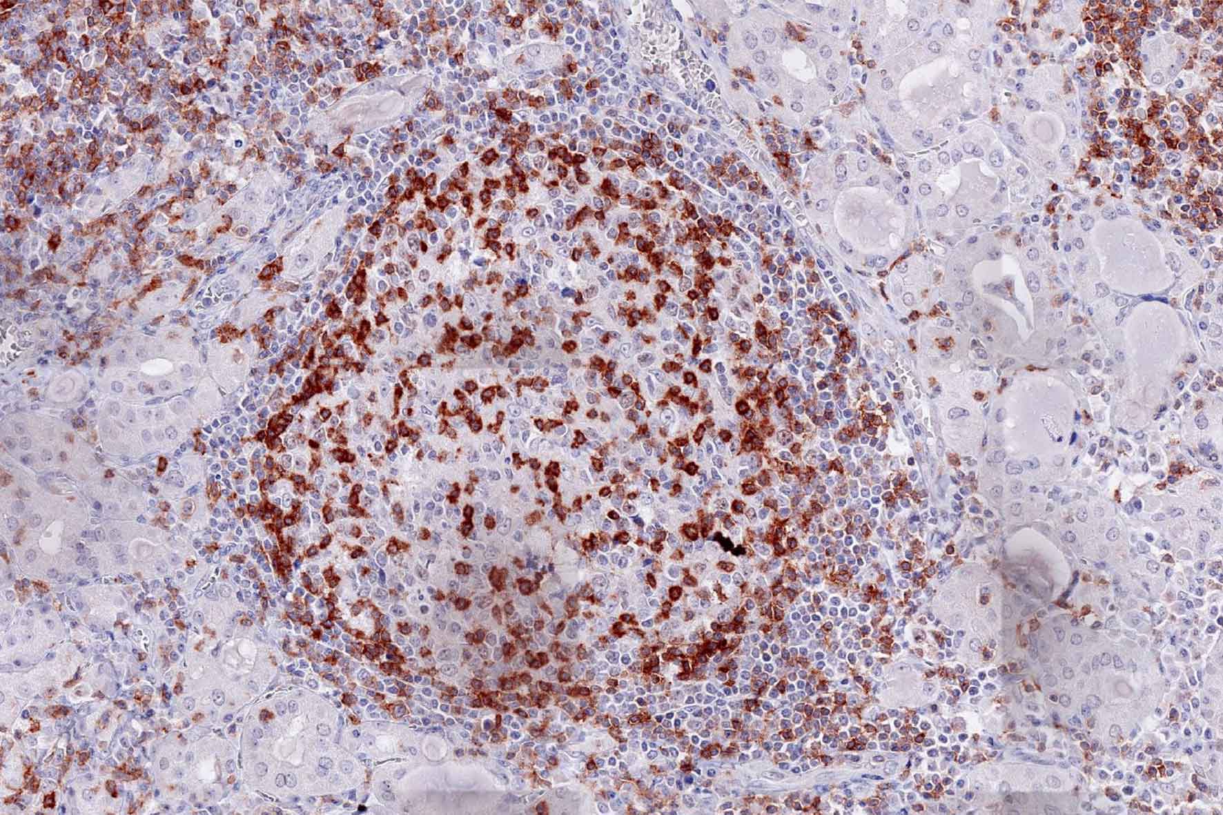 Product image of the ONCOdianova anti-TIGIT antibody clone TG1: TIGIT immunohistochemistry of an inflammatory lymphoid infiltrate in Hashimoto thyroiditis