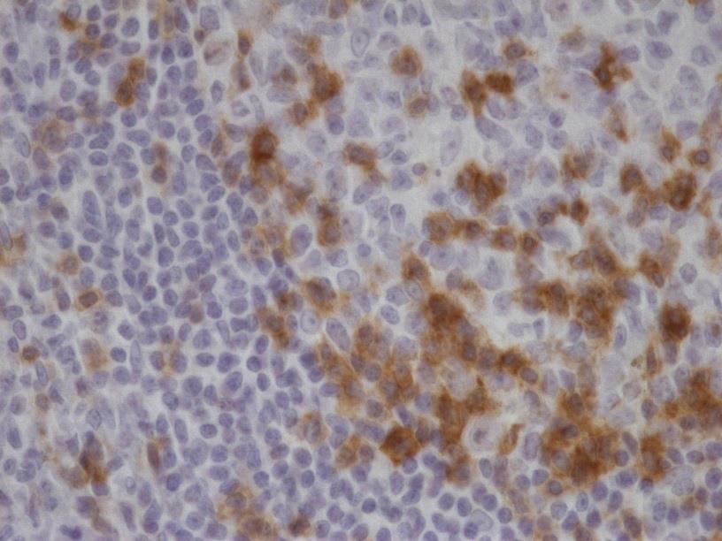 TIGIT immunohistochemistry with anti-TIGIT clone TG1, brightfield IHC: human tonsil at 400× magnification with membranous staining of TIGIT-positive lymphocytes (ONCOdianova reference image, not an Imaging Mass Cytometry image)