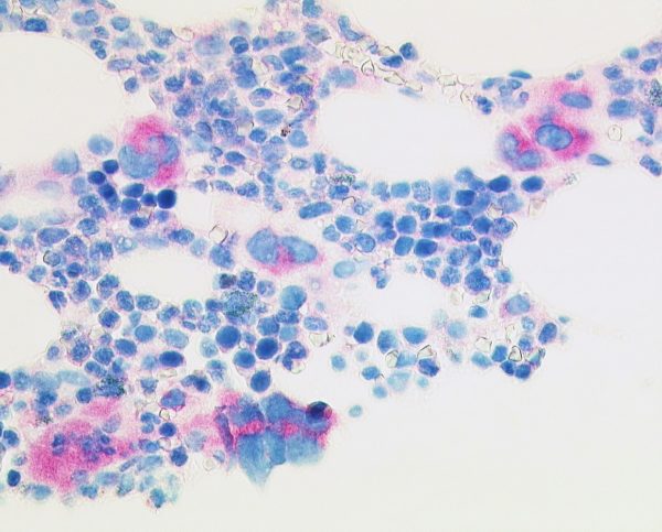 Selective stain of mutated CALR protein in megacaryocytes of essential thrombocythaemia (anti-CALRmut clone CAL2 1:50, Dako Omnis, 200x).