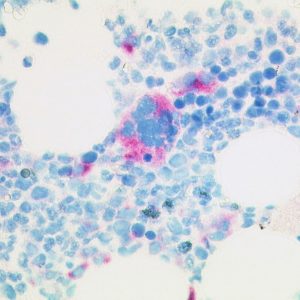 Selective stain of mutated CALR protein in megacaryocytes of early primary myelofibrosis (anti-CALRmut clone CAL2 1:50, Dako Omnis, 400x).